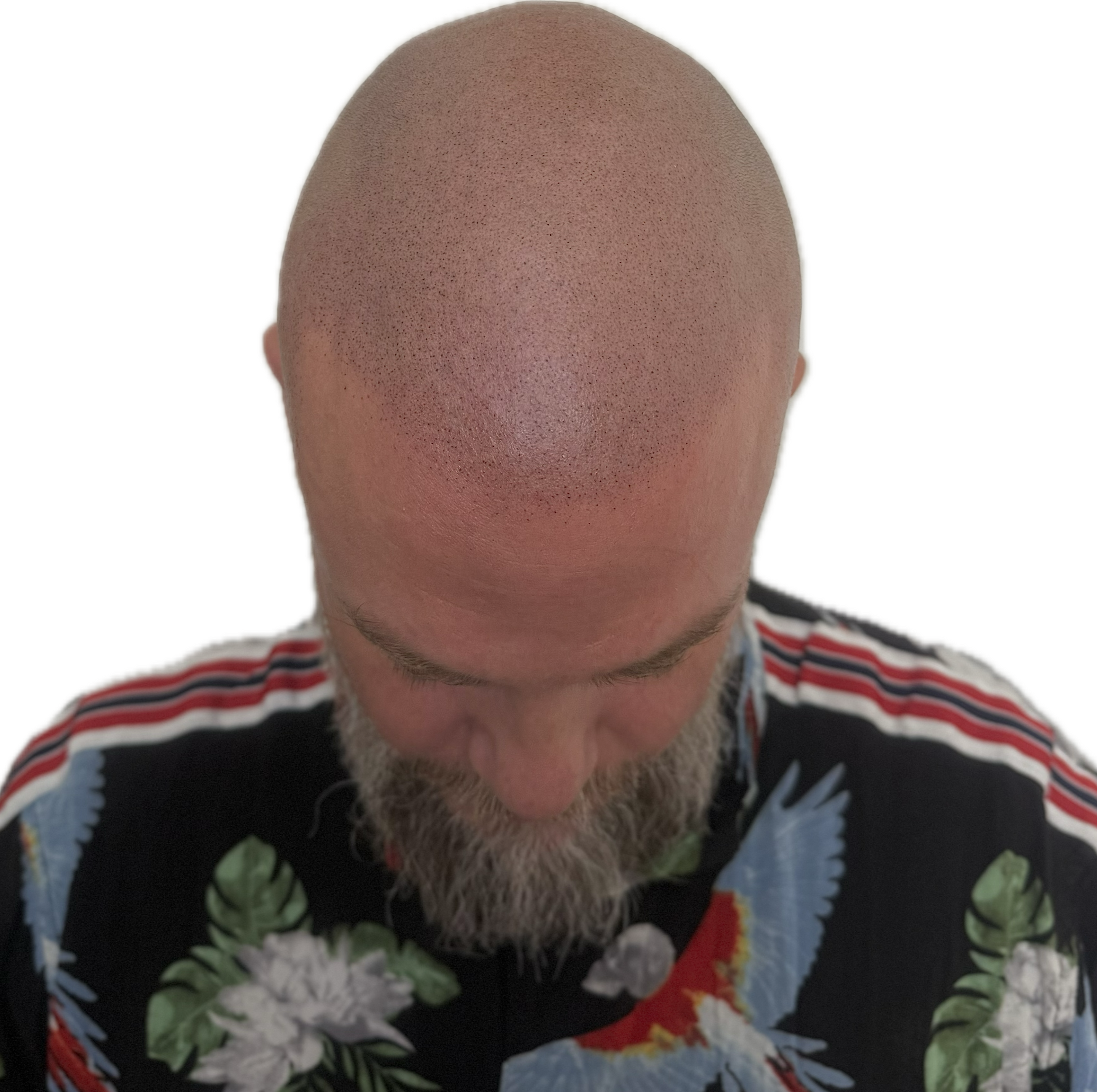 Hårbotten efter scalp micropigmentation