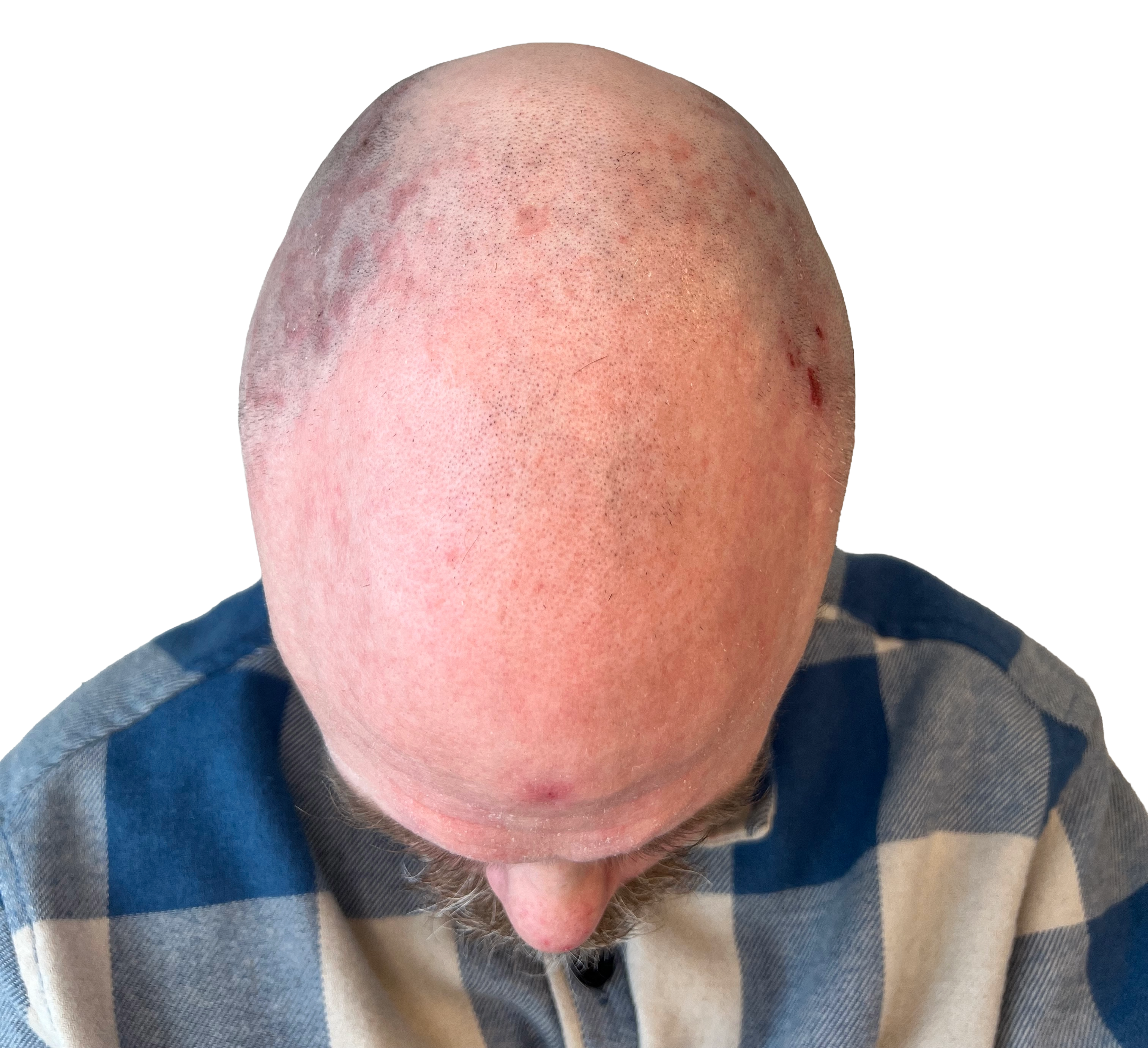 Hårbotten före scalp micropigmentation