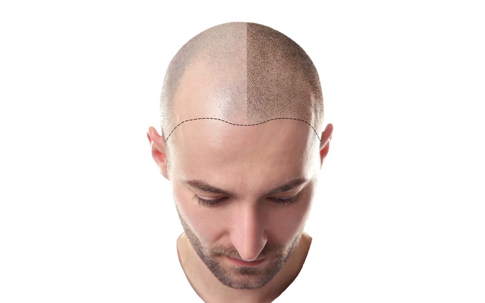 Grundbehandling vid scalp micropigmentation