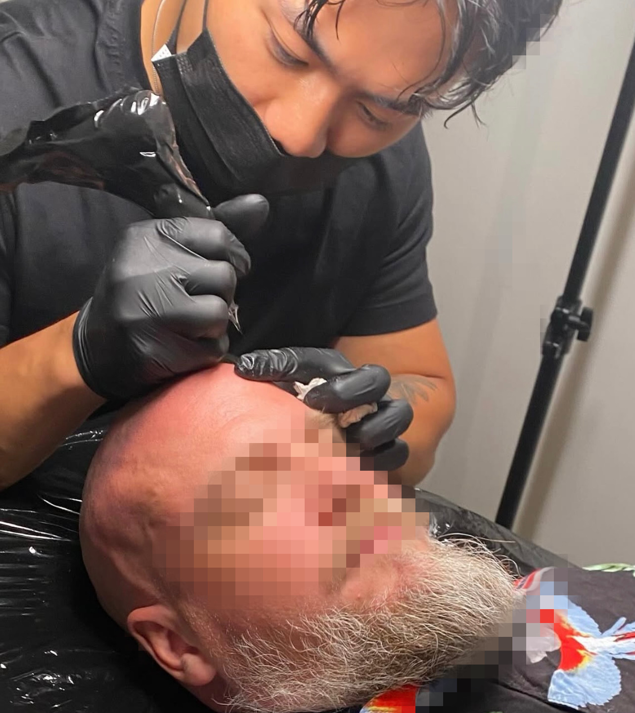 Scalp micropigmentation-behandling pågår