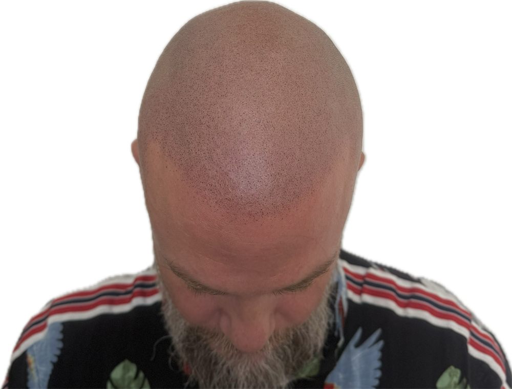 Samma kund efter SMP med rakad look